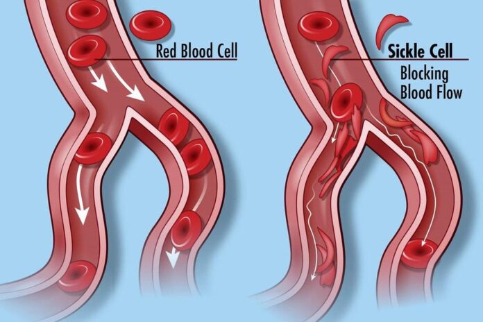 Sickle Cell